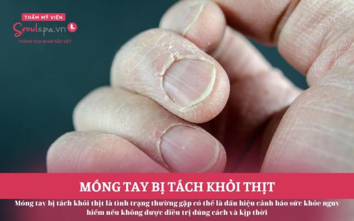 Móng chân bị tách khỏi thịt